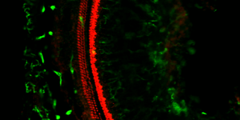 Hearing Loss in Chronic Suppurative Otitis Media