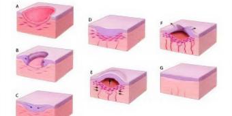 Oral Wound Healing